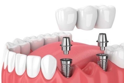 CẤY GHÉP IMPLANT